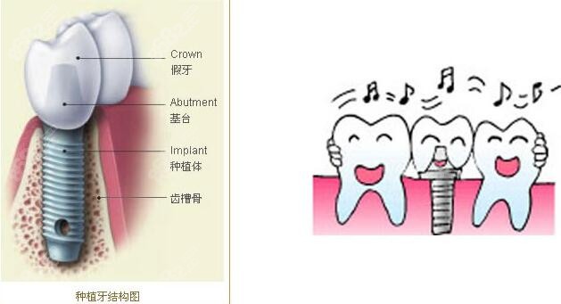泉州种植牙价格表