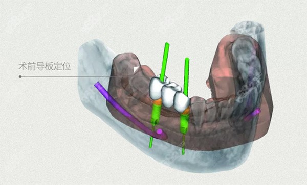 3D数字化导板种植牙术前定位
