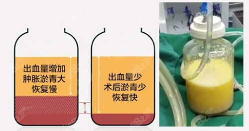 王俊河大腿吸脂技术