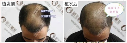 南京<!--<i data=20240705-sp></i>-->植发前后对比照