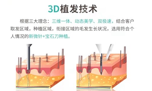 南京<!--<i data=20240705-sp></i>-->植发技术优势