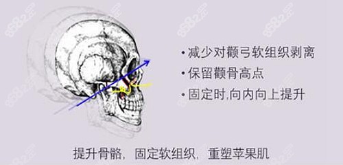 <!--<i data=20240705-sp></i>-->做颧骨后脸会下垂吗