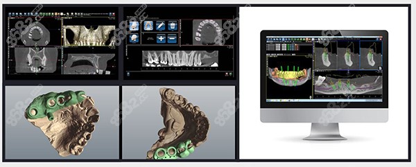 3D数字化种植牙的费用