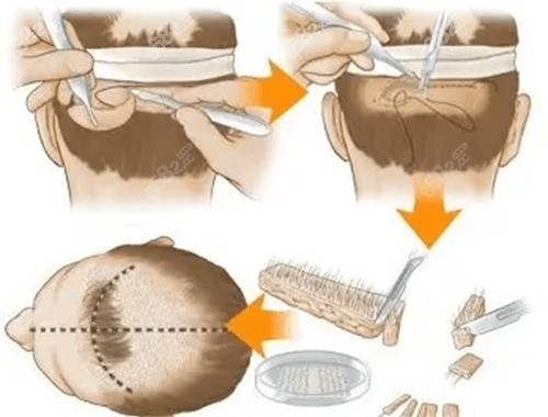 碧莲盛和<!--<i data=20240705-sp></i>-->植发技术差异 碧莲盛和<!--<i data=20240705-sp></i>-->植发技术差异