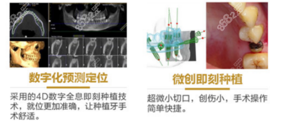 <!--<i data=20240705-sp></i>-->口腔种植牙技术