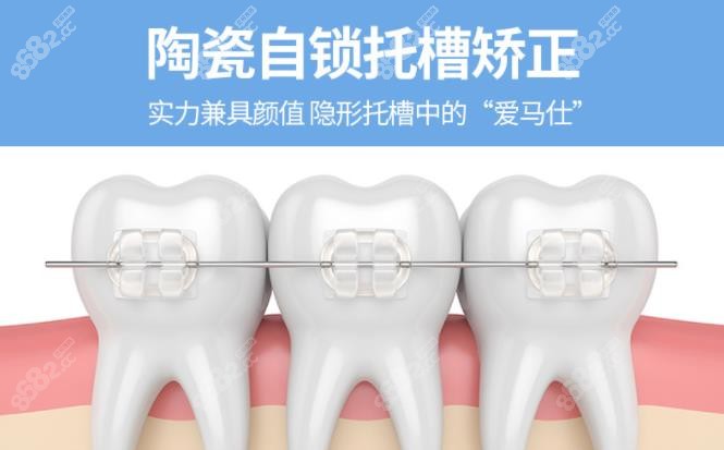 半隐形陶瓷矫正牙套多少钱