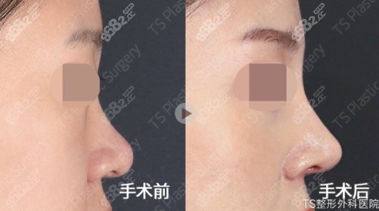 韩国TS福鼻（蒜头鼻）矫正前后对比