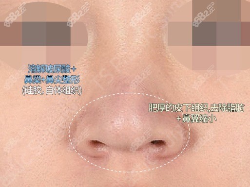 韩国TS福鼻（蒜头鼻）矫正改善方案