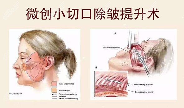 <!--<i data=20240705-sp></i>-->医生做的小切口提升示意图