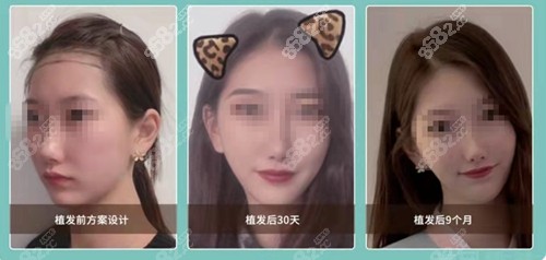 重庆丝粟植发际线前后对比明显