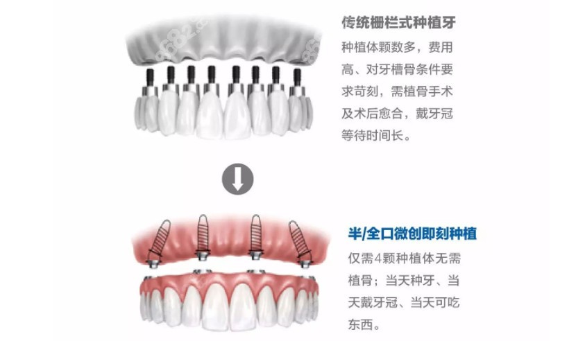 传统栅栏式种植牙和all-on-4微创种植牙的区别