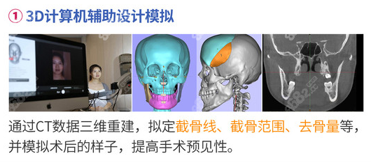 用3D技术来设计正颌手术方案 