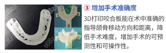 3D导板增加了正颌手术的准确度