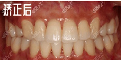 杭州植得口腔牙齿矫正