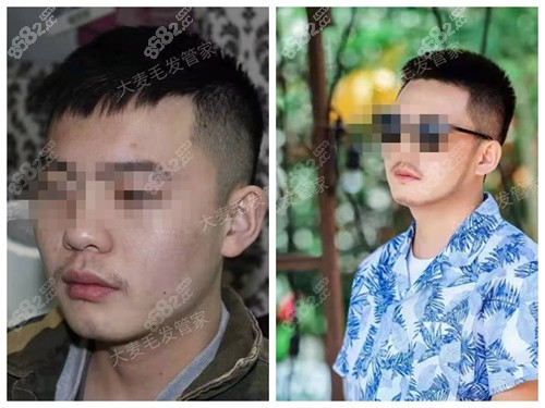 重庆大麦微针胡须种植对比照片