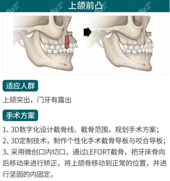 上颌前突的矫正方法