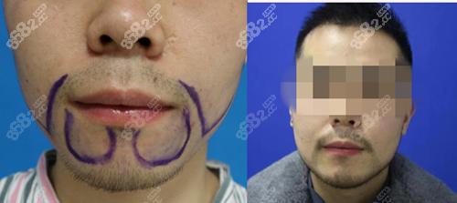 重庆唐森胡须种植对比照