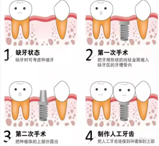 四医大种植牙流程