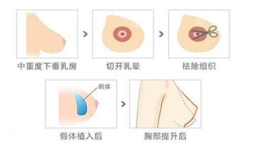 20211015188广州荔湾区人民医院做乳房下垂矫正