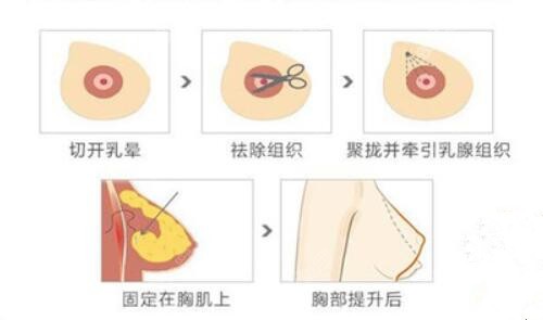 广州荔湾区人民医院做乳房下垂矫正优势一