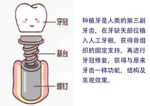 上海美奥牙齿种植