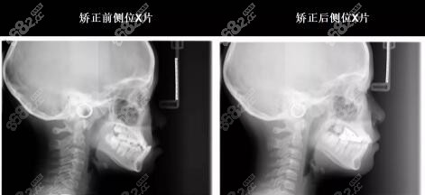 <!--<i data=20240705-sp></i>-->城西院区地包天矫正真人对比照