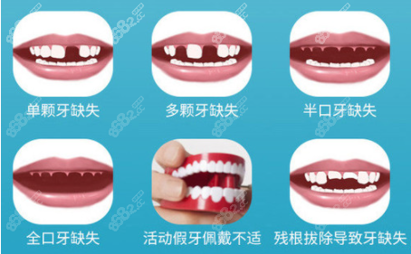 北<!--<i data=20240705-sp></i>-->腔哪家种植牙比较好呢？