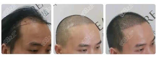 杭州薇琳植发前后对比照 杭州薇琳植发前后对比照