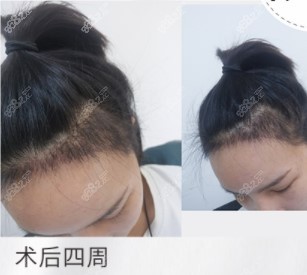 杭州薇琳植发发际线种植术后4周