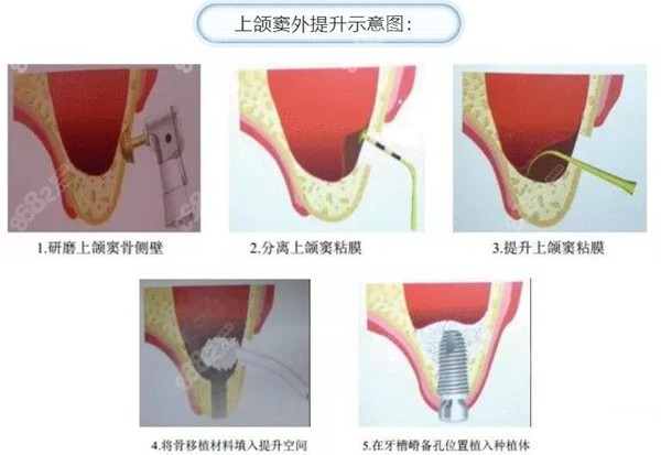 上颌窦外提升示意图