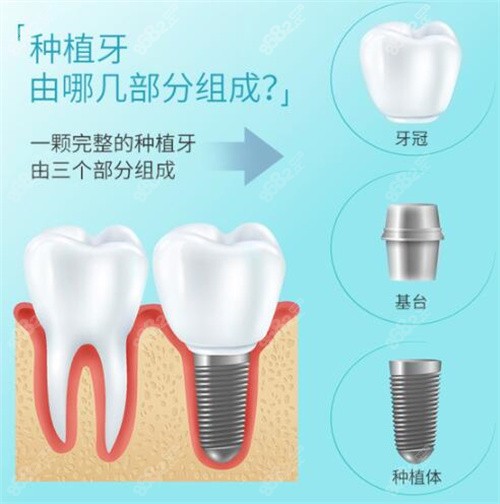 种植牙价格的决定因素