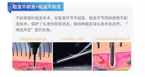 不剃发植发技术优势 不剃发植发技术优势