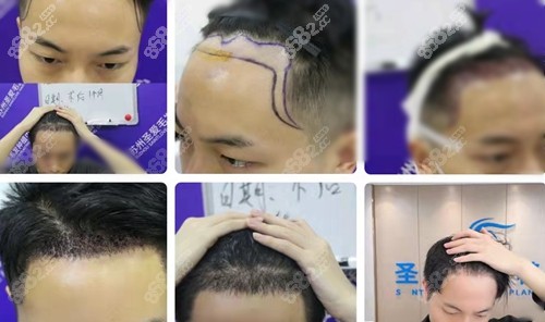 <!--<i data=20240705-sp></i>-->植发前后对比照 <!--<i data=20240705-sp></i>-->植发前后对比照