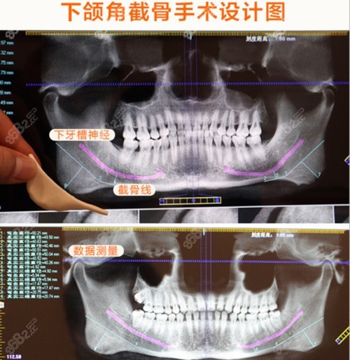 杭州连天美下颌角截骨设计图