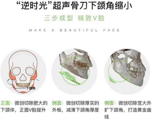 杭州时光下颌角磨骨优势介绍