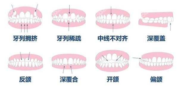 牙大夫口腔可做的复杂畸形牙齿