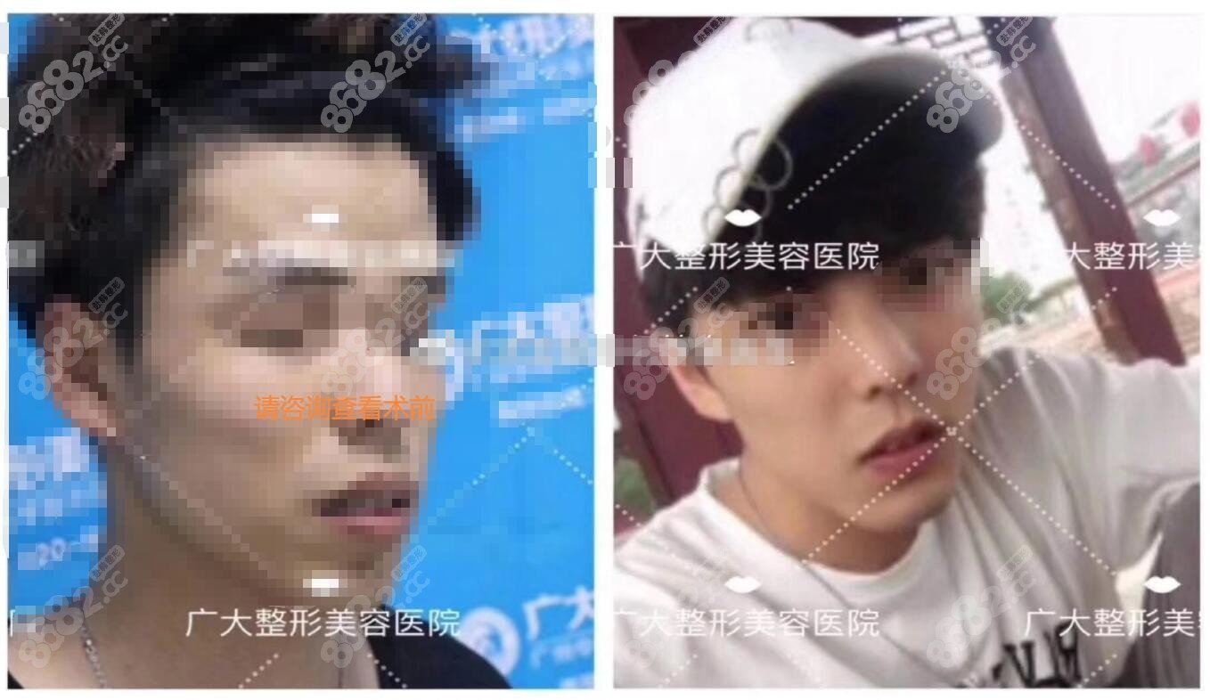 广州广大整形正颌手术术后