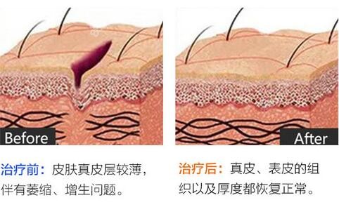 成都军建医院疤痕科修复疤痕皮肤前后对比示意图