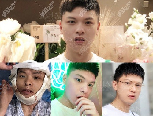 赵贵庆医生磨骨真实实例分享