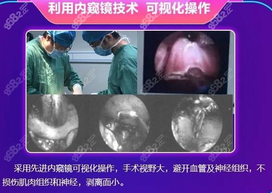 广州美恩磨骨内窥镜