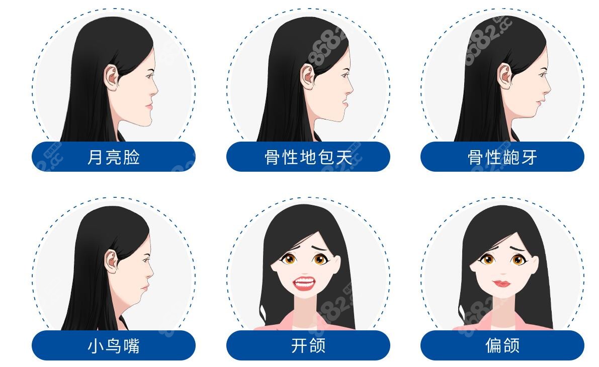 需要做正颌的面部特征