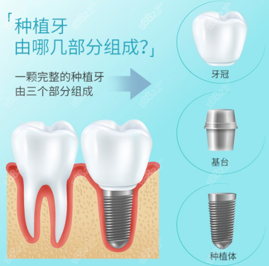 北京瑞达提醒你种植牙的组成部分