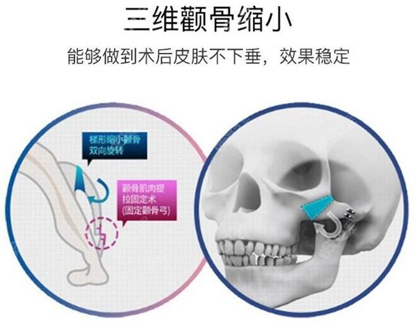 李志海颧骨缩小技术