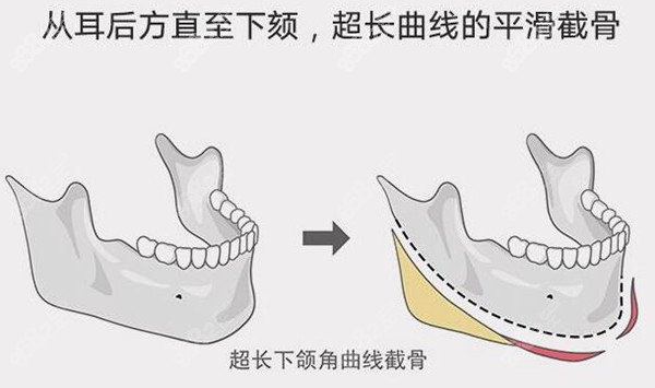 李志海超长曲线下颌角手术