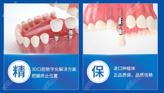 苏州美奥口腔种牙优势