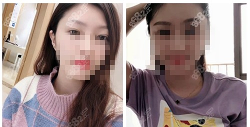 眉毛种植价格贵不?,毛发整形对比照-8682赴韩整形网