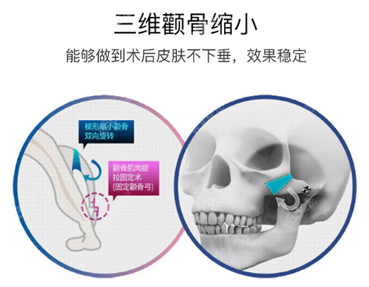上海华美颧骨内推整形没注意