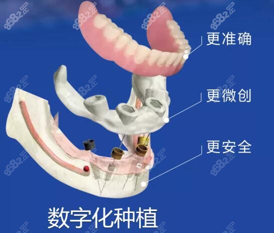 长沙中诺立得用数字化种植牙