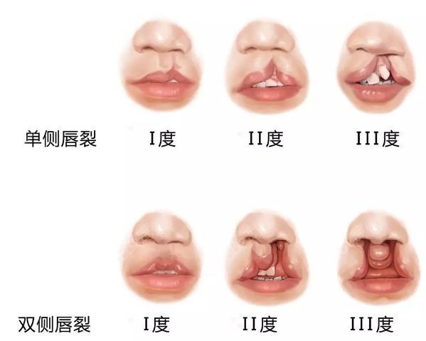 郑医生可做高难度的唇腭裂术后畸形再次整形美容术