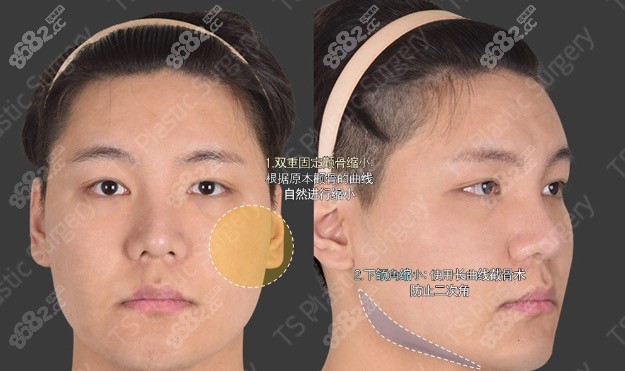 韩国TS男士面部轮廓手术方案分析